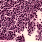 myelomaCB